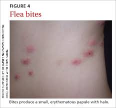 Image result for flea bites