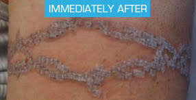 Tattoo removal north east ,durham,teeside,sunderland. The Laser Tattoo Removal Process Vanishing Ink Tattoo Removal Sydney