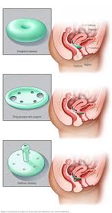Endometrial cancer is cancer of the endometrium, which is the lining of the uterus. Uterine Prolapse Diagnosis And Treatment Mayo Clinic