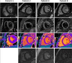 Myocarditis can occur when any infectious disease, but currently myocarditis is most often seen in. Cardiac Mri Aids Evaluation Of Children With Multisystem Inflammatory Syndrome Mis C Associated With Covid 19 Daic