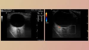 Image result for Acute Vision Loss