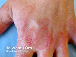 Image result for Erythema Multiforme Major