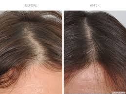 Read about prp treatment for hair loss in men and women. Prp Hair Treatment Before After Photo Gallery Haircaremd Nyc