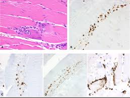 Myocarditis is an inflammatory disease of cardiac muscle that is caused by a variety of infectious and noninfectious conditions (). Nivolumab And Ipilimumab Induced Myositis And Myocarditis Mimicking A Myasthenia Gravis Presentation Neuromuscular Disorders