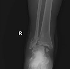 Image result for Ankle XRay