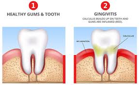 Younger children may also be offered this treatment if your dentist thinks they need it. Treatment Of Gingivitis Or Bleeding Gums In Preston Lancashire