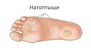 как избавиться от мозолей на пальцах ног в домашних условиях Let 15 Nazad Etim Sposobom Podelilas So Mnoj Podruzhka V 2020 G Tovary Dlya Zdorovya Produkty Dlya Zdorovya Lichnaya Gigiena