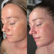 When your friend messages asking you what's your secret 🤫 No it's not  Botox it's BioRePeel 💚 BioRePeel is our most popular treatment because of  its many benefits. It helps treat acne,