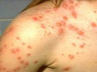 I batteri possono colpire varie parti del corpo, dalla pelle ai polmoni. Infezione Da Staphylococcus Nei Bambini Come Non Perdere Pericolo Malattie Infettive Infezione Da Stafilococco