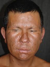 Infection: Bacteria, Spirochetes, Protozoa, and Infestation