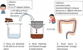 Image result for Fecal Transfer