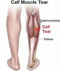 Find out more about the gastrocnemius and soleus (calf) muscles here. Pulled Calf Muscle Causes Symptoms Treatment
