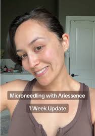 Can I Use Qure Microneedling Once Per Week