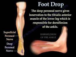 Pin By Sue Gutro On Sports Ortho Pt Foot Drop Exercises Foot Drop Foot Exercises