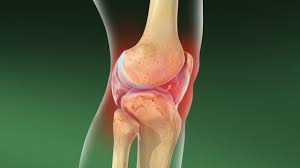 Image result for Septic Joint