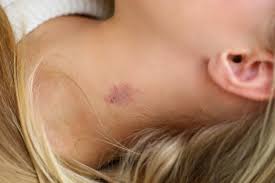 There's surprisingly little research done on hickeys, but the general consensus is that they last about one to two weeks. How To Give Yourself A Hickey 17 Tips That Really Work Her Norm