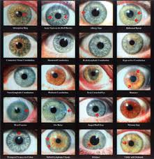 41 rigorous iris diagnosis chart