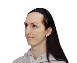 Lise Marie Before and After FFS Surgery — Facialteam