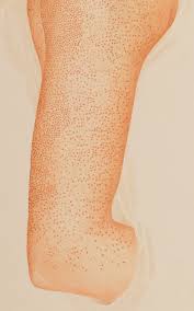 L41.0 pityriasis lichenoides et varioliformis acuta; Pityriasis Rubra Pilaris Wikipedia