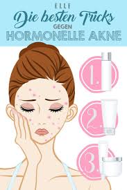 Hormonelle Akne Ursachen Und Wie Du Sie Loswerden Kannst Hormonelle Akne Akne Hautprobleme