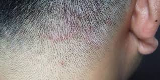 Panu panu merupakan penyakit kulit yang memiliki ciri khas timbulnya bercak putih pada kulit. Bagaimana Cara Mengobati Kurap Kulit Kepala Tinea Capitis