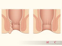 Перианальные бахромки: норма и патология