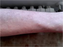 Persistent, prolonged high fever (4 days or more) lethargy skin rash or discoloration (pale, patchy or blue skin) red eyes, lips and tongue swollen hands and feet no appetite, difficulty feeding in. An Itchy Erythematous Papular Skin Rash As A Possible Early Sign Of Covid 19 A Case Report Journal Of Medical Case Reports Full Text