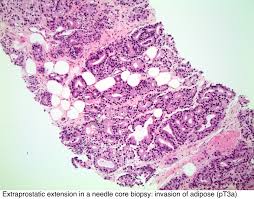 Figo stage is based on the international federation of gynecology and obstetrics system. Pathology Outlines Staging
