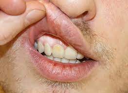 Etter lengre tids fast snusing blir slimhinnen hvitlig, fortykket og rynkete. Snus Indeholder Mange Kemiske Stoffer Danske Tandplejere