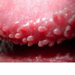 Résultat de recherche d'images pour "papilloma penis"