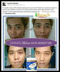 'baking soda' atau soda penaik ini terkenal dengan bahan 1001 kegunaan, termasuklah untuk menghilangkan parut jerawat. 7 Produk Hilangkan Parut Jerawat Hitam Dan Berlubang Secara Semulajadi Amizah Azid