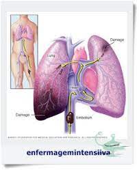 Enfermagem Atualizada Embolia Pulmonar Pulmonary Embolism Pulmonary Embolism Survivor Pulmonary