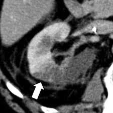 Image result for Renal Infarction