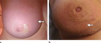 However, this kind of cancer can develop and spread quickly (said to be aggressive). Clinical Features Of Ibc A Photograph Of The Right Breast In A Download Scientific Diagram