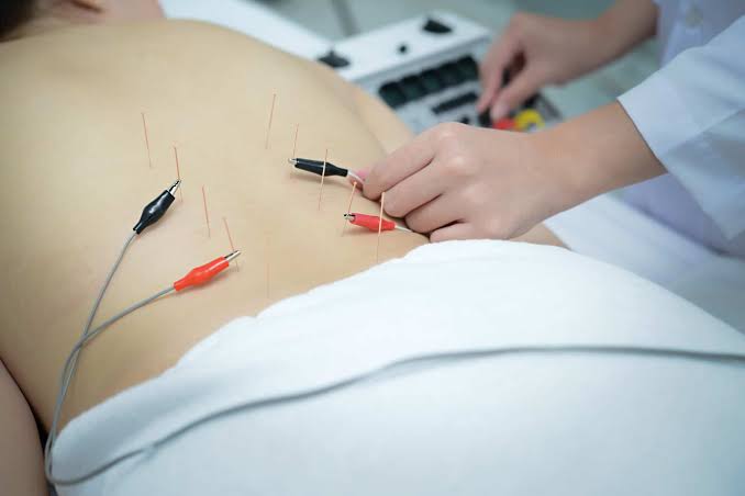 Electro-Acupuncture in Dubai at Yuan Qi Acupuncture Center, Business Bay Dubai