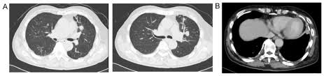 (ct), magnetic resonance (mr), positron . Double Cancer Comprising Malignant Pleural Mesothelioma And Squamous Cell Carcinoma Of The Lung Treated With Radiotherapy A Case Report