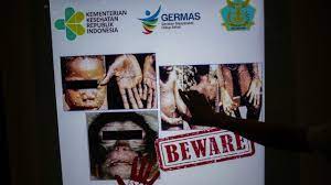 Most cases have been in africa. We667u4jq7xvlm