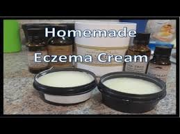 homemade eczema cream you
