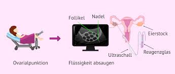 Follikelpunktion So Werden Die Eizellen In Einer Ivf Entnommen