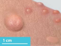 Image result for Papule