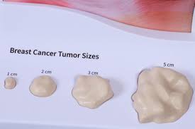 Image result for Breast Cancer Staging