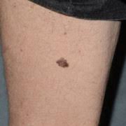 Moreover, it can spread rather easily to other parts of the body. Spot The Difference Dermnet Nz
