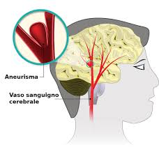 • intraparenchimale •primitiva (ipertensione, angiopatia amiloide) l'emorragia cerebrale primaria rappresenta l'80% circa di tutte le emorragie cerebrali ed è causata. Aneurisma Cerebrale Sintomi Conseguenze Cause
