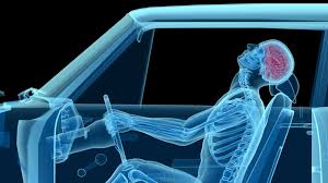 Although whiplash can be quite minor and resolve after a few weeks, more serious circumstances mean that you could be suffering for up to a year. Whiplash Causes Symptoms And Treatments
