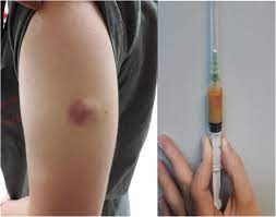 A Case Of Recurrent Sterile Abscesses Following Tetanus Diphtheria Vaccination Treated With Corticosteroids Bmc Infectious Diseases Full Text