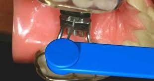 How To Turn An Rpe Rapid Palatal Expander Nirenblatt Orthodontics Orthodontics Dental Fun Orthodontia