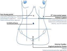 It is situated in the midclavicular line, about 3 cm below the costal margin, and is used in patients with known or anticipated umbilical adhesions. Principles Of Safe Laparoscopic Entry European Journal Of Obstetrics And Gynecology And Reproductive Biology