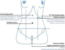 Palmer is a general surgeon in high point, nc. Principles Of Safe Laparoscopic Entry European Journal Of Obstetrics And Gynecology And Reproductive Biology