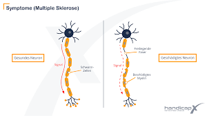 Multiple sklerose (ms) ist eine neurologische erkrankung, bei der das immunsystem köpereigene strukturen des zentralen nervensystems angreift und zerstört. Multiple Sklerose Ms Themenwelt Handicapx De