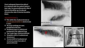 Patients most commonly present with dyspnea, initially on exertion. Epos
